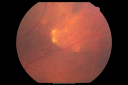 sclerochoroidalcalcificationpali_28529.png