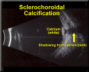 sclerochoroidalcalcificationpali_28829.png