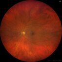 serpiginous2_117484_121223_37.jpg