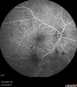 serpiginous_117484_103123_12.jpg