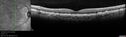 soft-Drusen_cafau_061617_03.jpg