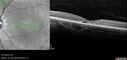 stargardt-mild_pacai_121622_22.jpg