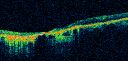 stargartsgeographicatrophy_waja16.jpg