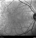 syphilis1_mialc_04122022_05.jpg