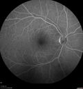 syphilis1_mialc_04122022_13.jpg
