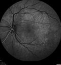 syphilis1_mialc_04122022_15.jpg
