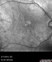 systemic_avastin_021715_26.jpg