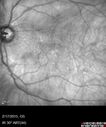 systemic_avastin_021715_27.jpg