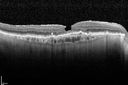 systemic_avastin_021715_28.jpg