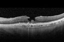 systemic_avastin_021715_31.jpg