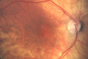 systemic_avastin_102114_01.png