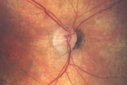 systemic_avastin_102114_02.png