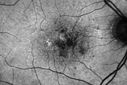 systemic_avastin_102114_05.jpg