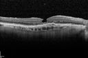 systemic_avastin_102114_08.jpg