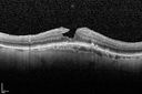 systemic_avastin_102114_11.jpg