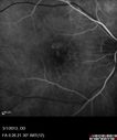 systemic_avastin_102114_12.jpg