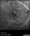 systemic_avastin_102114_14.jpg