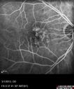 systemic_avastin_102114_15.jpg