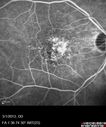 systemic_avastin_102114_16.jpg