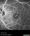 systemic_avastin_102114_18.jpg