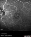 systemic_avastin_102114_19.jpg