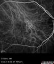 systemic_avastin_102114_20.jpg