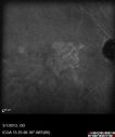 systemic_avastin_102114_21.jpg