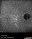 systemic_avastin_102114_22.jpg