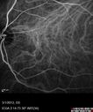 systemic_avastin_102114_23.jpg