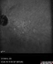 systemic_avastin_102114_25.jpg