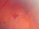 tearbeforelaser_chdo23.png