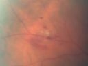 tearvithemepreandpostlaser_ropl02.jpg