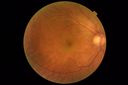 tumor_jetop_042419_03.JPG