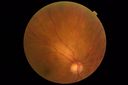tumor_jetop_042419_05.JPG