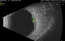 tumor_jetop_042419_39.png