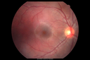 uveitis_cme_shgra_102313_03.png
