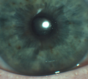 vemurafenib_jofi_030218_28129.png