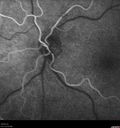 venous-anomaly_caflo_04.jpg