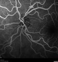 venous-anomaly_caflo_05.jpg