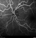 venous-anomaly_caflo_06.jpg