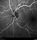 venous-anomaly_caflo_07.jpg
