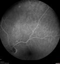 venous-anomaly_caflo_09.jpg