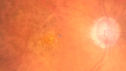 venousMA2-deho_110118_postlaser_11.JPG