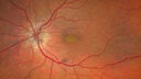vitelliform-psdrusen_saedw_083123_02.jpg