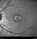 vitelliform-psdrusen_saedw_083123_04.jpg