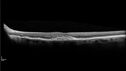 vitelliform-psdrusen_saedw_083123_09.jpg