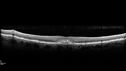 vitelliform-psdrusen_saedw_083123_10.jpg