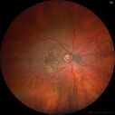 wetAMD-Classic_becos_082420__01.jpg
