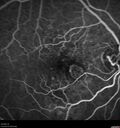 wetAMD-Classic_becos_082420__12.jpg