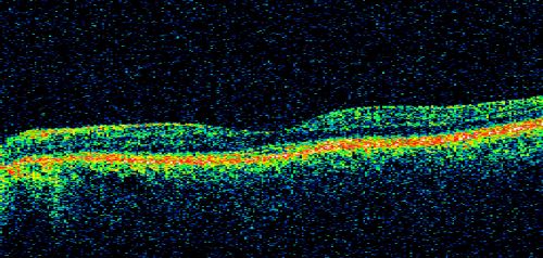 Chronic Central Serous Retinopathy - Gutter in Both Eyes - Treated with PDT - Visudyne
69-year-old man with blurred vision in the right eye for about three weeks.  He had a similar episode about twenty years ago which lasted about six weeks.  He is not taking any steroids.  He takes Lupron injections for his prostate cancer every three months. 

VISUAL ACUITY:  Vision OD is 20/80
FU: Treated with PDT after 6 months of observation with success.  Treatment was done to area between nerve and fovea at 1/2 fluence.
Keywords: csr;visudyne;chronic;gutter;serous